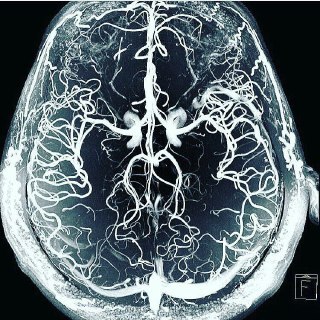 Enferdom_angiografia cerebral